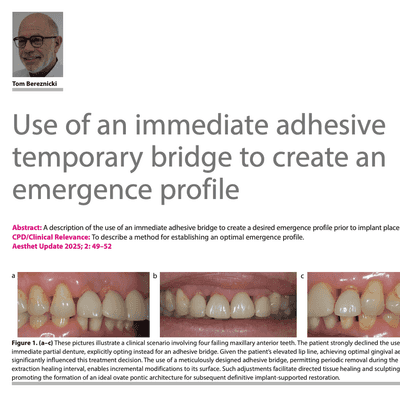 Use of an immediate adhesive temporary bridge to create an emergence profile
