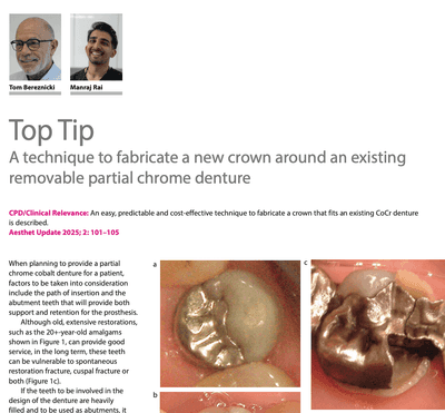A technique to fabricate a new crown around an existing removable partial chrome denture