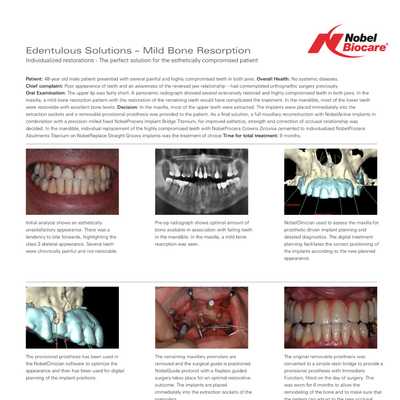 Edentulous solutions – No/mild Bone Resorbtion