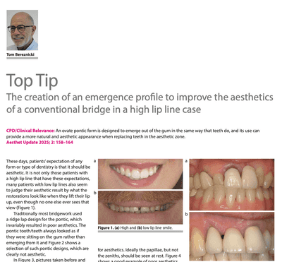 The creation of an emergence profile to improve the aesthetics of a conventional bridge in a high lip line case